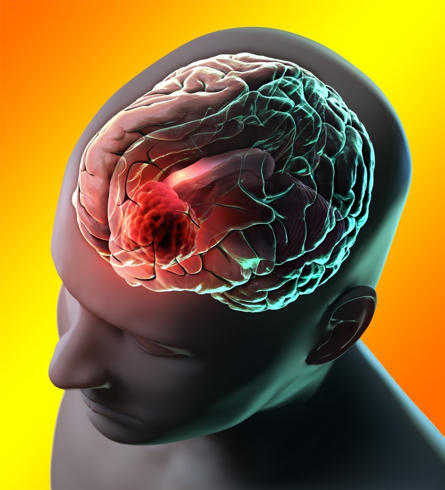 Противопоказания при менингиоме мозга thumbnail