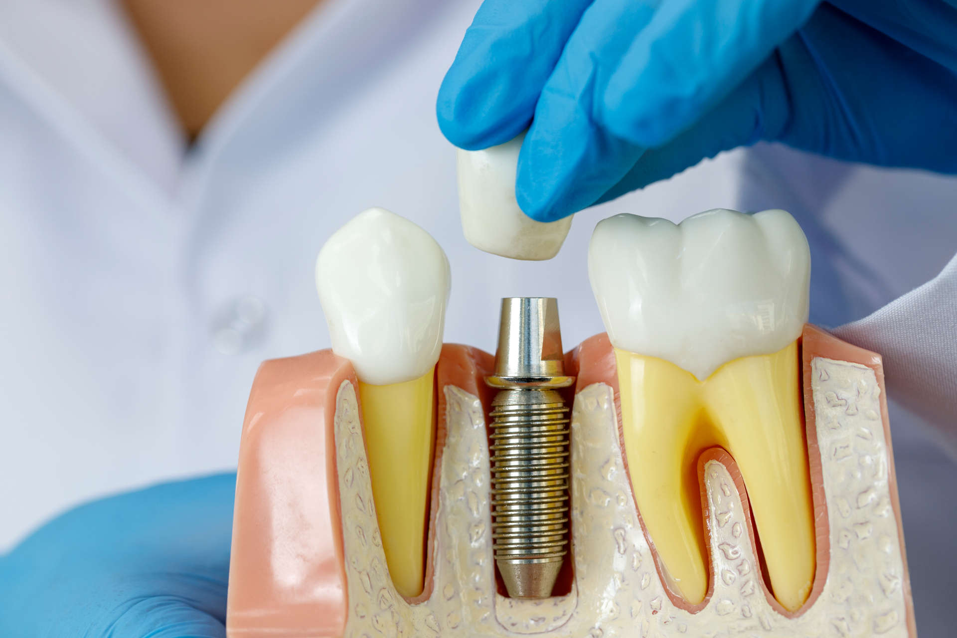 Dental-Gigi-Implant