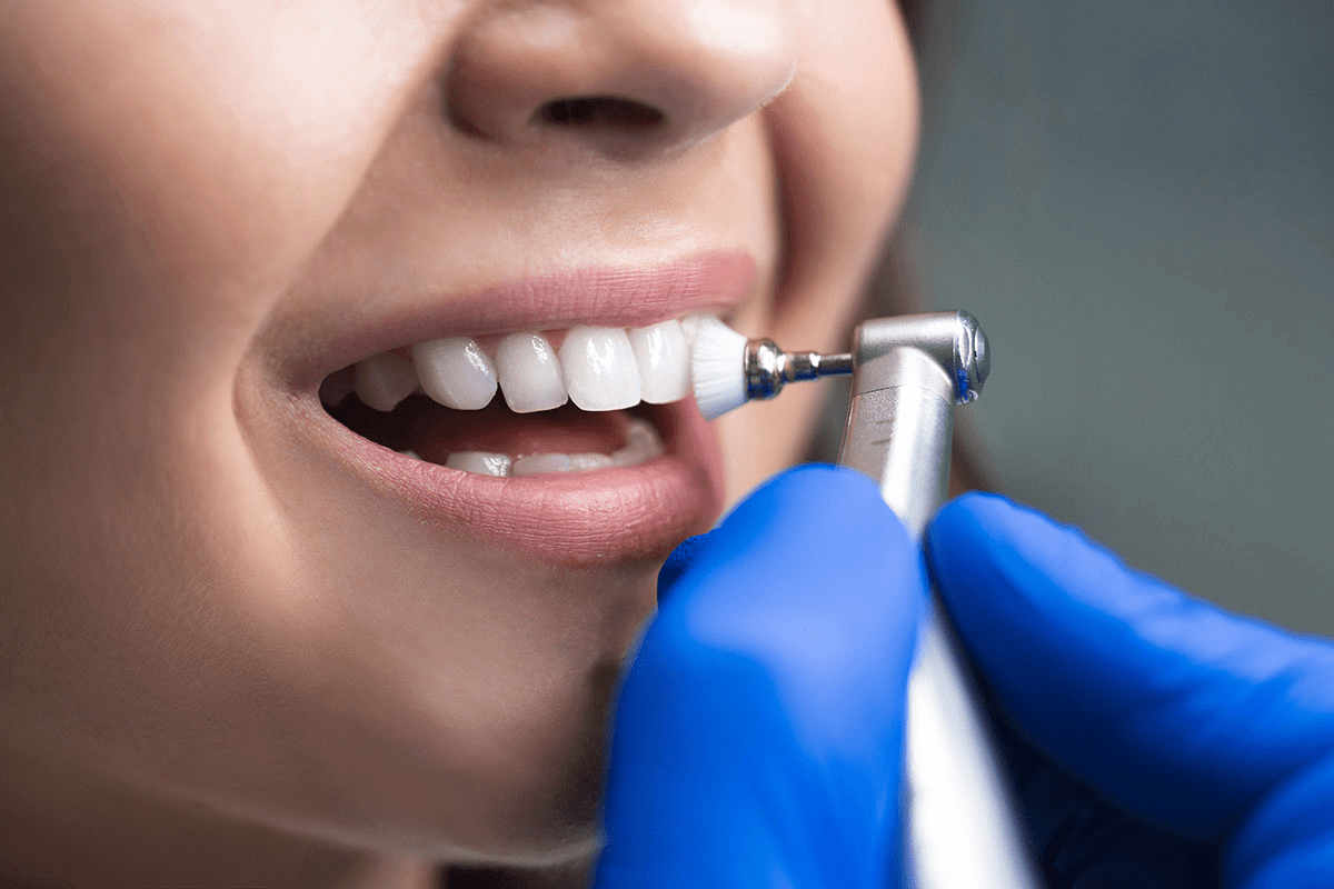 professionalnaya-chistka-zubov